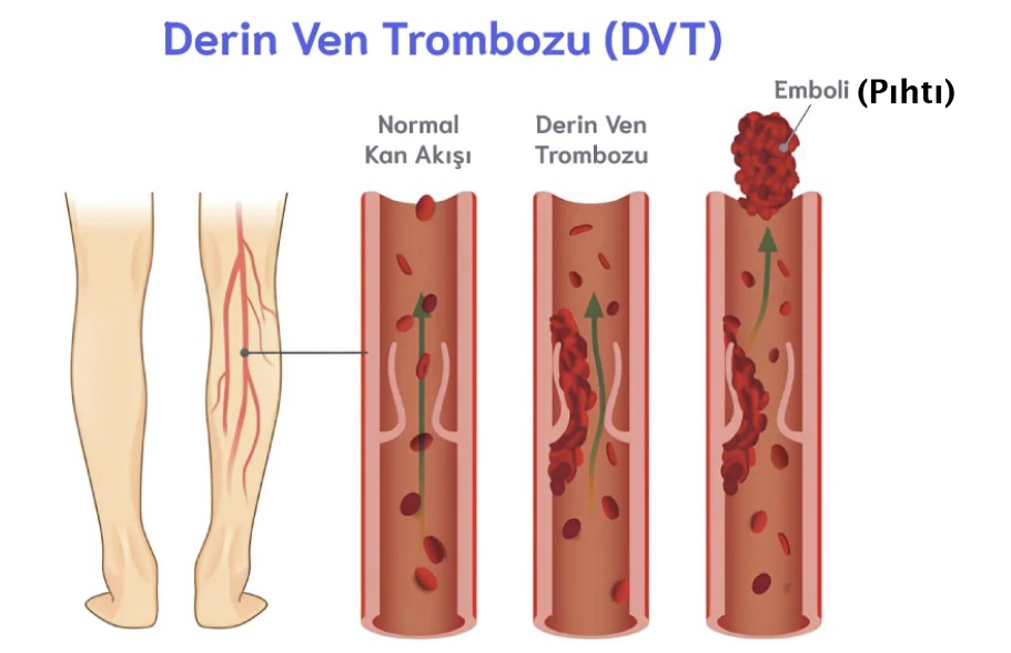 Derin Ven Trombozu