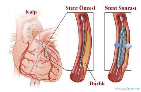 Stent tedavisi